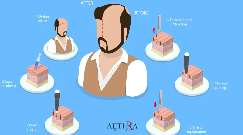 Why Patients Consider Slovakia For Hair Restoration