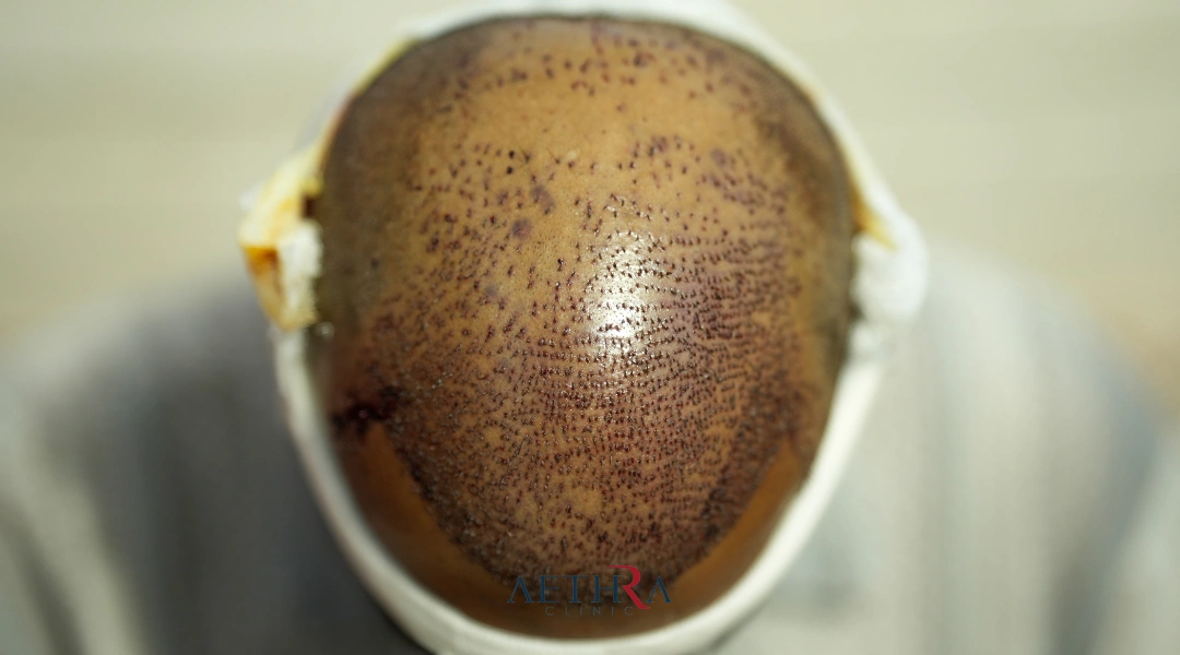 afro hair transplant