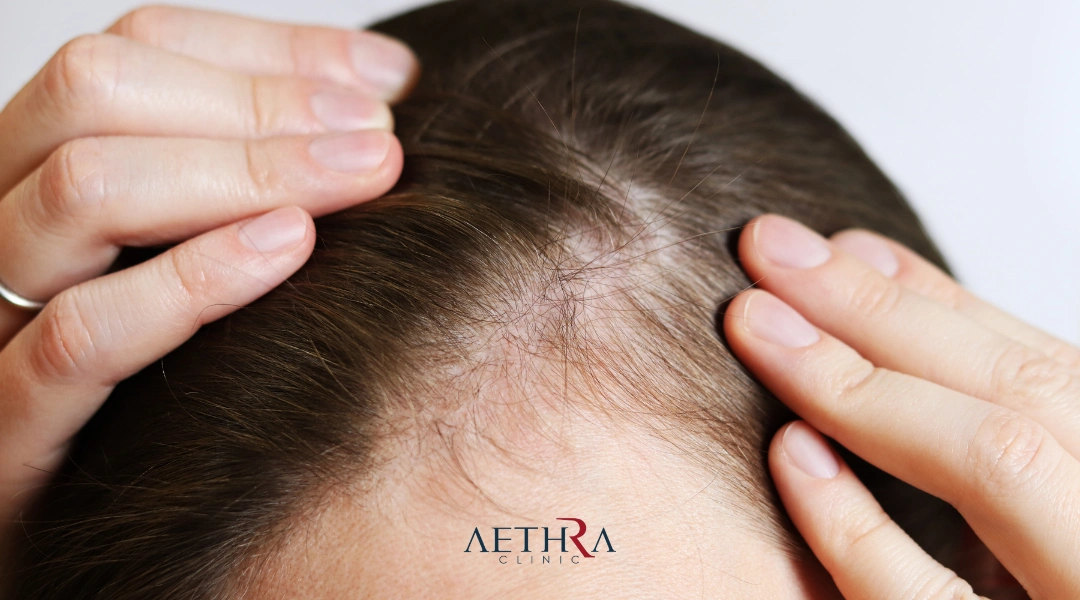 female hair transplant