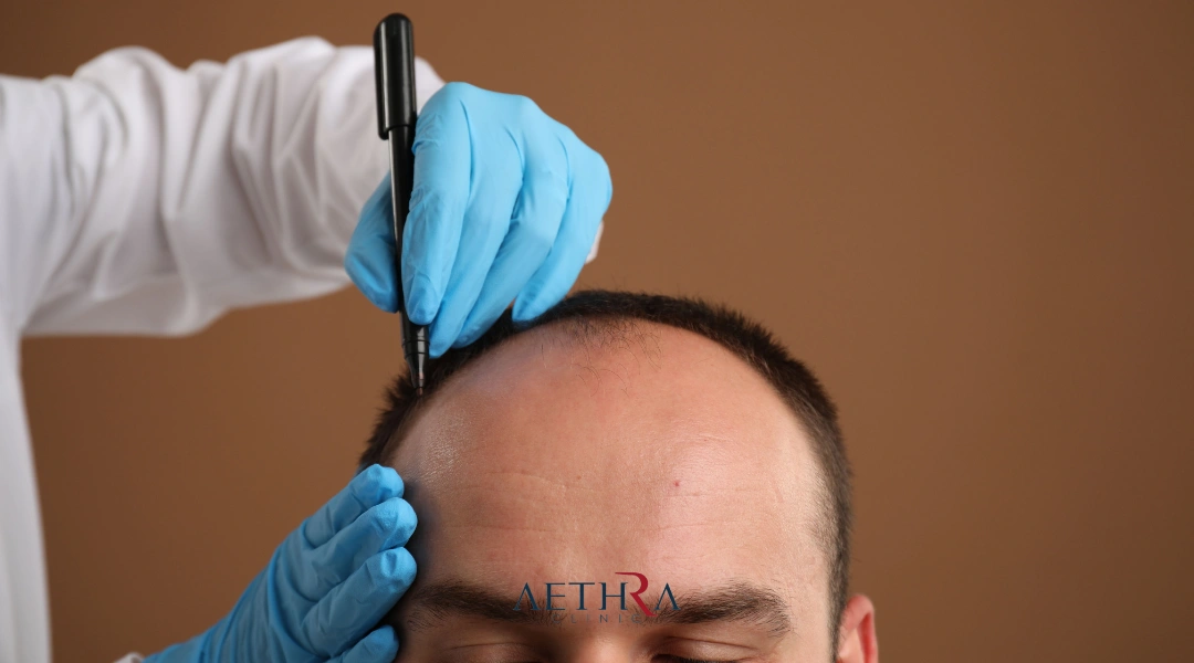 mens hair transplant