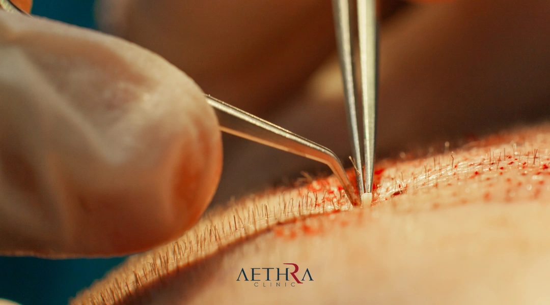 sapphire fue hair transplant
