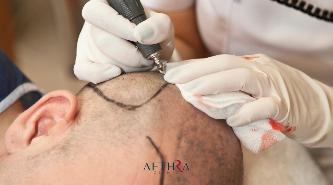 sapphire fue hair transplant