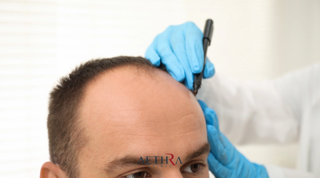 why turkey leader a hair transplant