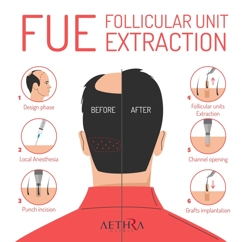 FUE The Gold Standard for Natural Results