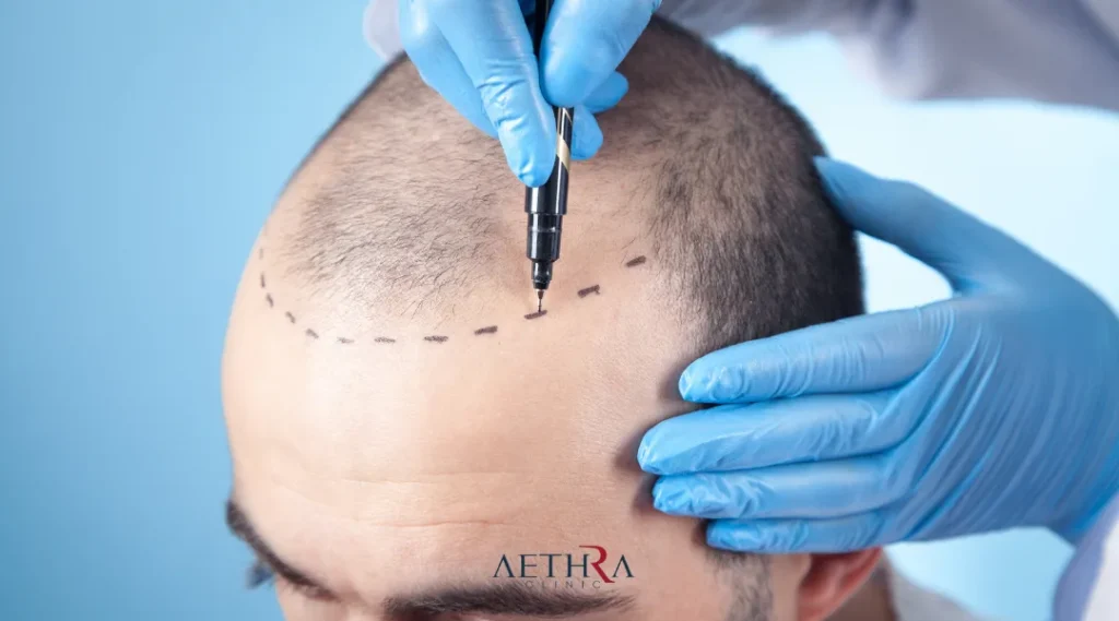 Men Hair Transplant
