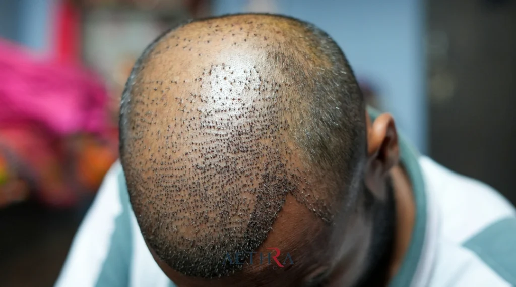 afro hair transplant