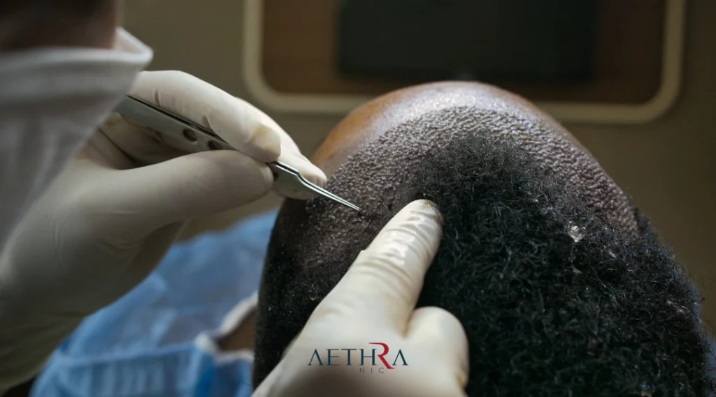 sapphire fue hair transplant