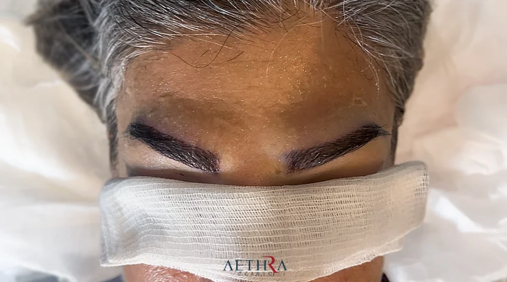 Eyebrow Transplant Turkey